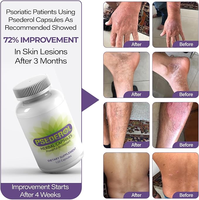 Psoriasis Support for Skin, 120 Herbal 6 Antioxidant